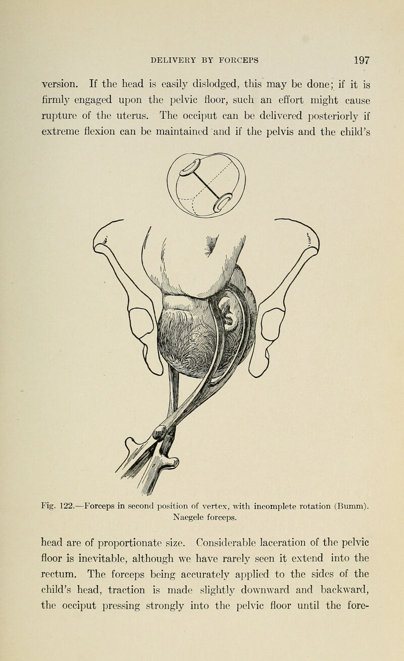 version. If the head is easily dislodged, this may be done; if it is firmly engaged upon the pelvic floor, such an effort might cause rupture of the uterus. The occiput can be dehvered posteriorly if extreme flexion can be maintained and if the pelvis and the child's Fig. 122.—Forceps in second position of vertex, with incomplete rotation (Bumm). Naegele forceps. head are of proportionate size. Considerable laceration of the pelvic floor is inevitable, although we have rarely seen it extend into the rectum. The forceps being accurately applied to the sides of the child's head, traction is made slightly downward and backward, the occiput pressing strongly into the pelvic floor until the fore-
