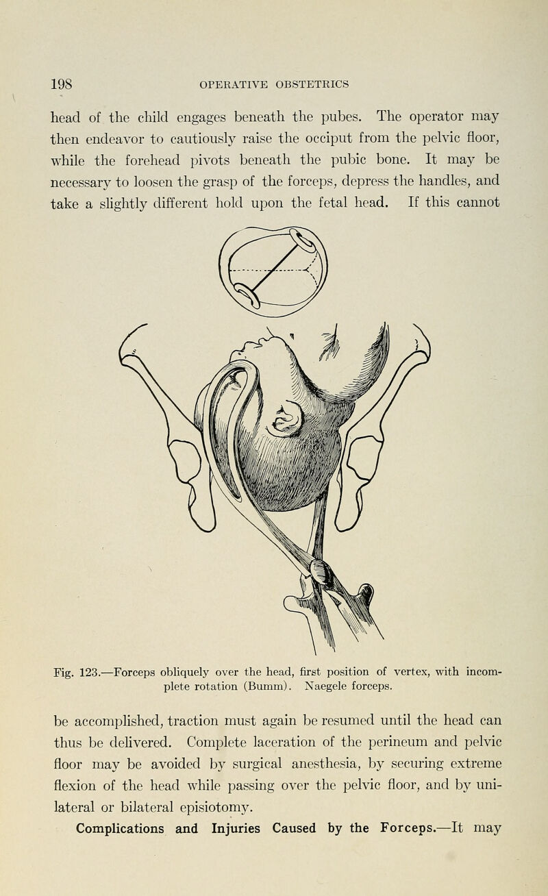 head of the child engages beneath the pubes. The operator may then endeavor to cautiously raise the occiput from the pelvic floor, while the forehead pivots beneath the pubic bone. It may be necessary to loosen the grasp of the forceps, depress the handles, and take a slightly different hold upon the fetal head. If this cannot Fig. 123.—Forceps obliquely over the head, first position of vertex, with incom- plete rotation (Bumm). Naegele forceps. be accomplished, traction must again be resumed until the head can thus be delivered. Complete laceration of the perineum and pelvic floor may be avoided by surgical anesthesia, by securing extreme flexion of the head while passing over the pelvic floor, and by uni- lateral or bilateral episiotomy. Complications and Injuries Caused by the Forceps.—It may