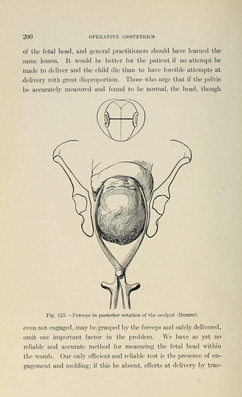 of the fetal head, and general practitioners should have learned the same lesson. It would be better for the patient if no attempt be made to deliver and the child die than to have forcible attempts at delivery with great disproportion. Those who urge that if the pelvis be accurately measured and found to be normal, the head, though Fig. 125.—Forceps in posterior rotation of the occiput (Bumm). even not engaged, may be grasped by the forceps and safely delivered,, omit one important factor in the problem. We have as yet nO' reliable and accurate method for measuring the fetal head within the womb. Our only efficient and reliable test is the presence of en- gagement and molding; if this be absent, efforts at delivery by trac-
