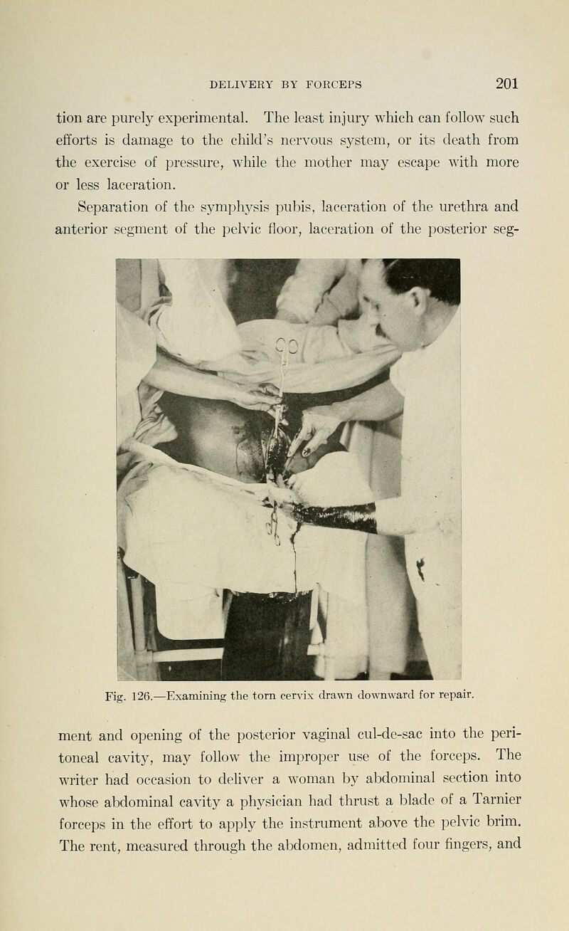 tion are purely experimental. The least injury which can follow such efforts is damage to the child's nervous system, or its death from the exercise of pressure, while the mother may escape with more or less laceration. Separation of the symphysis pubis, laceration of the urethra and anterior segment of the pelvic floor, laceration of the posterior seg- Fig. 126.—Examining the torn cervix drawn downward for repair. ment and opening of the posterior vaginal cul-de-sac into the peri- toneal cavity, may follow the improper use of the forceps. The writer had occasion to dehver a woman by abdominal section into whose abdominal cavity a physician had thrust a blade of a Tarnier forceps in the effort to apply the instrument above the pelvic brim. The rent, measured through the abdomen, admitted four fingers, and