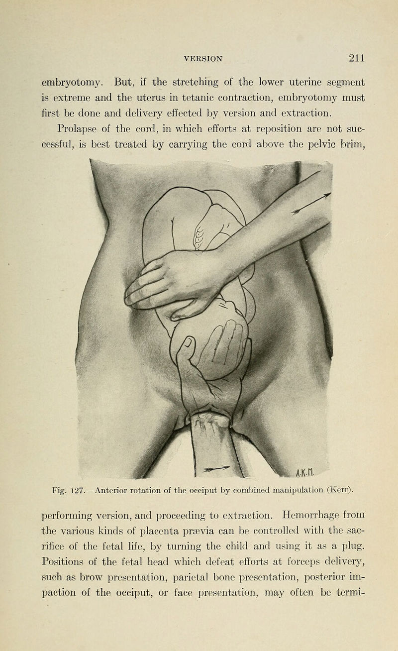embryotomy. But, if the stretching of the lower uterine segment is extreme and the uterus in tetanic contraction, embryotomy must first be done and dehvery effected by version and extraction. Prolapse of the cord, in which efforts at reposition are not suc- cessful, is best treated by carrying the cord above the pelvic brim, AK-n. Fig. 127.—Anterior rotation of the occiput by combined manipulation (Kerr). performing version, and proceeding to extraction. Hemorrhage from the various kinds of placenta prsevia can be controlled with the sac- rifice of the fetal life, by turning the child and using it as a plug. Positions of the fetal head which defeat efforts at forceps delivery, such as brow presentation, parietal bone presentation, posterior im- paction of the occiput, or face presentation, may often be termi-