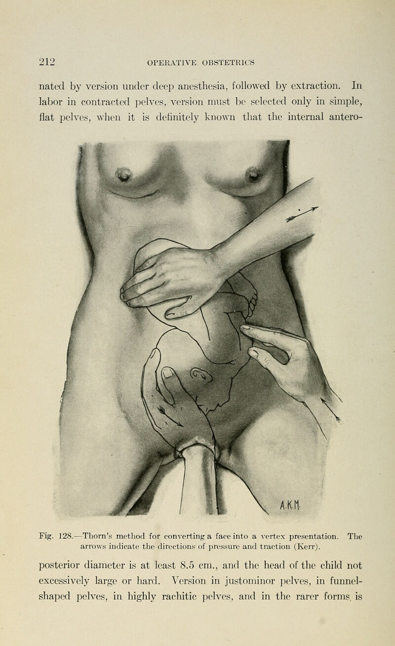 nated by version under deep anesthesia, followed by extraction. In labor in contracted pelves, version must be selected only in simple, flat pelves, when it is definitely known that the internal antero- Fig. 128.—Thorn's method for converting a face into a vertex presentation, arrows indicate the directions of pressure and traction (Kerr). The posterior diameter is at least 8.5 cm., and the head of the child not excessively large or hard. Version in justominor pelves, in funnel- shaped pelves, in highly rachitic pelves, and in the rarer forms, is