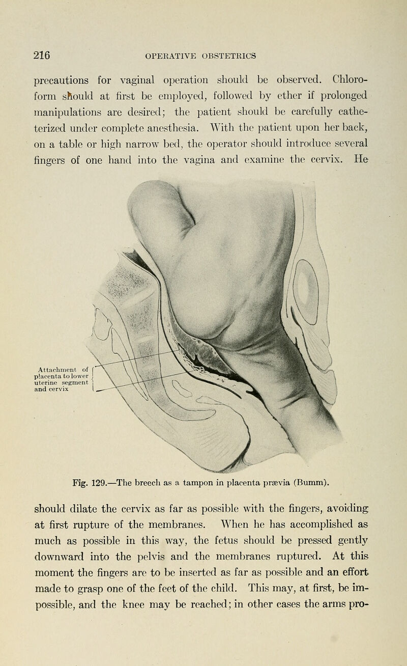 precautions for vaginal operation should be observed. Chloro- form should at first be employed, followed by ether if prolonged manipulations are desired; the patient should be carefully cathe- terized under complete anesthesia. With the patient upon her back, on a table or high narrow bed, the operator should introduce several fingers of one hand into the vagina and examine the cervix. He Attachment of placenta to lower uterine segment } and cervix Fig. 129.—The breech as a tampon in placenta praevia (Bumm). should dilate the cervix as far as possible with the fingers, avoiding at first rupture of the membranes. When he has accomplished as much as possible in this way, the fetus should be pressed gently downward into the pelvis and the membranes ruptured. At this moment the fingers are to be inserted as far as possible and an effort made to grasp one of the feet of the child. This may, at first, be im- possible, and the knee may be reached; in other cases the arms pro-