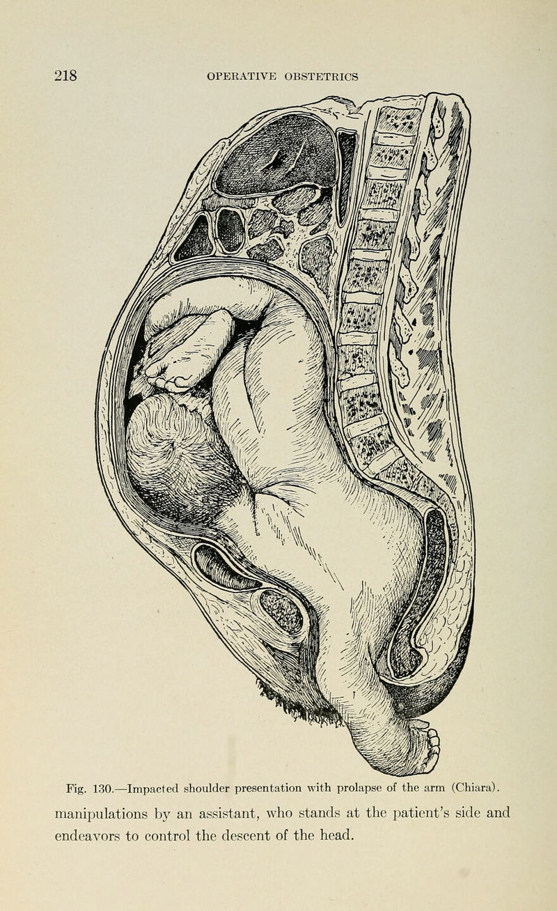 Fig. 130.—Impacted shoulder presentation with prolapse of the arm (Chiara). manipulations by an assistant, who stands at the patient's side and endeavors to control the descent of the head.