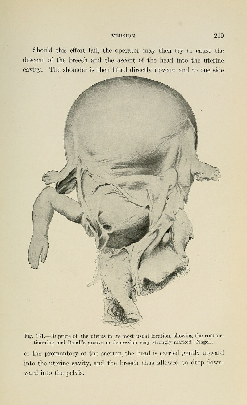 Should this effort fail, the operator may then try to cause the descent of the breech and the ascent of the head into the uterine cavity. The shoulder is then lifted dircftly upward and to one side ^V '^^ Fig. 131.—Rupture of the uterus in its most usual location, showing the contrac- tion-ring and Bandl's groove or depression very strongly marked (Nagel). of the promontory of the sacrum, the head is carried gently upward into the uterine cavity, and the breech thus allowed to drop down- ward into the pelvis.