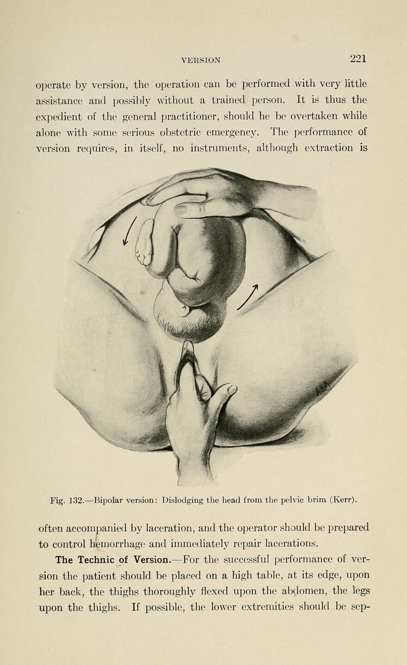 operate b}^ version, the operation can be performed with very little assistance and possibly without a trained person. It is thus the expedient of the general practitioner, should he be overtaken while alone with some serious obstetric emergency. The performance of version requires, in itself, no instruments, although extraction is Fig. 132.—Bipolar version: Dislodging the head from the pelvic brim (Kerr). often accompanied by laceration, and the operator should be prepared to control hemorrhage and immediately repair lacerations. The Technic of Version.—For the successful performance of ver- sion the patient should be placed on a high table, at its edge, upon her back, the thighs thoroughly flexed upon the abdomen, the legs upon the thighs. If possible, the lower extremities should be sep-