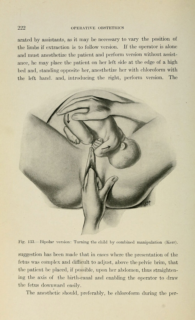 arated by assistants, as it may be necessary to vary the position of the hmbs if extraction is to follow version. If the operator is alone and must anesthetize the patient and perform version without assist- ance, he may place the patient on her left side at the edge of a high bed and, standing opposite her, anesthetize her with chloroform with the left hand, and, introducing the right, perform version. The Fig. 133.—Bipolar version: Turning the child by combined manipulation (Kerr). suggestion has been made that in cases where the presentation of the fetus was complex and difficult to adjust, above the pelvic brim, that the patient be placed, if possible, upon her abdomen, thus straighten- ing the axis of the birth-canal and enabling the operator to draw the fetus downward easily. The anesthetic should, preferably, be chloroform during the per-