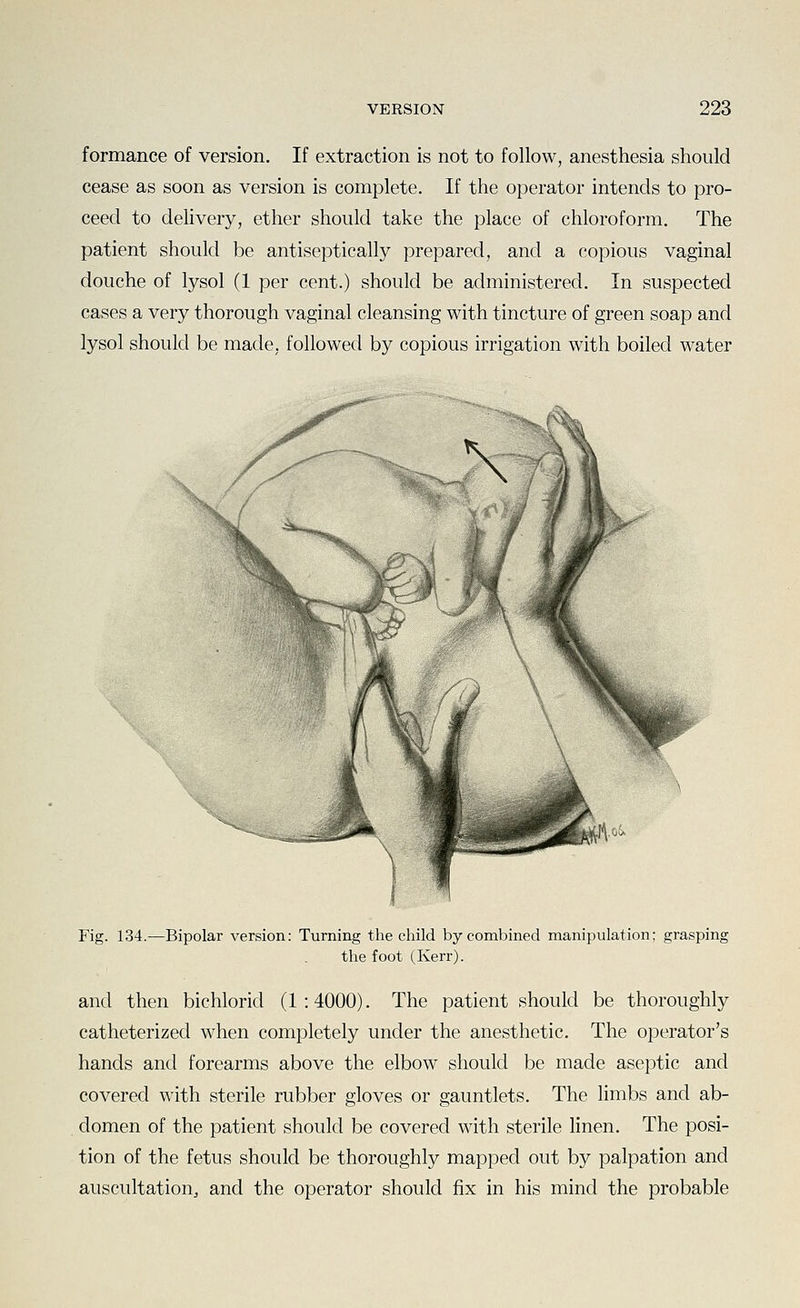 formance of version. If extraction is not to follow, anesthesia should cease as soon as version is complete. If the operator intends to pro- ceed to delivery, ether should take the place of chloroform. The patient should be antiseptically prepared, and a copious vaginal douche of lysol (1 per cent.) should be administered. In suspected cases a very thorough vaginal cleansing with tincture of green soap and lysol should be made, followed by copious irrigation with boiled water Fig. 134.—Bipolar version: Turning the child by combined manipulation; grasping the foot (Kerr). and then bichlorid (1 : 4000). The patient should be thoroughly catheterized when completely under the anesthetic. The operator's hands and forearms above the elbow should be made aseptic and covered with sterile rubber gloves or gauntlets. The limbs and ab- domen of the patient should be covered with sterile linen. The posi- tion of the fetus should be thoroughly mapped out by palpation and auscultation^ and the operator should fix in his mind the probable