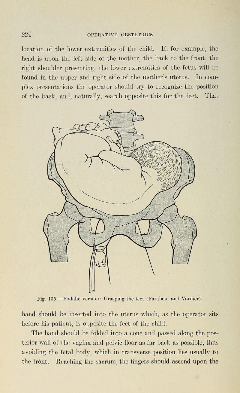location of the lower extremities of the child. If, for example, the head is upoia the left side of the mother, the back to the front, the right shoulder presenting, the lower extremities of the fetus will be found in the upper and right side of the mother's uterus. In com- plex presentations the operator should try to recognize the position of the back, and, naturally, search opposite this for the feet. That Fig. 135.—Podalic version: Grasping the feet (Farabeuf and Varnier). hand should be inserted into the uterus which, as the operator sits before his patient, is opposite the feet of the child. The hand should be folded into a cone and passed along the pos- terior wall of the vagina and pelvic floor as far back as possible, thus avoiding the fetal body, which in transverse position lies usually to the front. Reaching the sacrum, the fingers should ascend upon the