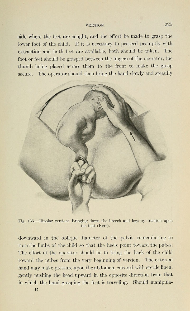 side where the feet are sought, and the effort be made to grasp the lower foot of the child. If it is necessary to proceed promptly with extraction and both feet are available, both should be taken. The foot or feet should be grasped between the fingers of the operator, the thumb being placed across them to the front to make the grasp secure. The operator should then bring the hand slowly and steadily Fig. 136.—Bipolar version: Bringing down the breech and legs by traction upon the foot (Kerr). downward in the oblique diameter of the pelvis, remembering to turn the limbs of the child so that the heels point toward the pubes. The effort of the operator should be to bring the back of the child toward the pubes from the very beginning of version. The external hand may make pressure upon the abdomen, covered with sterile linen, gently pushing the head upward in the opposite direction from that in which the hand grasping the feet is traveling. Should manipula- 15