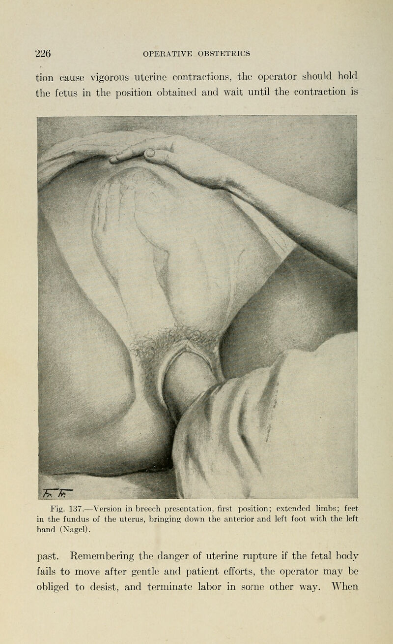 tion cause vigorous uterine contractions, the operator should hold the fetus in the position obtained and wait until the contraction is Fig. 137.—Version in breech presentation, first position; extended limbs; feet in the fundus of the uterus, bringing down the anterior and left foot with the left hand (Nagel). past. Remembering the danger of uterine rupture if the fetal body fails to move after gentle and patient efforts, the operator may be obliged to desist, and terminate labor in some other way. When