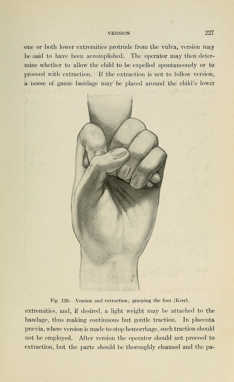 one or both lower extremities protrude from the vulva, version may be said to have been accomplished. The operator may then deter- mine whether to allow the child to be expelled spontaneously or to proceed with extraction. If the extraction is not to follow version, a noose of gauze bandage may be placed around the child's lower Fig. 138.—Version and extraction; grasping the foot (Kerr). extremities, and, if desired, a light weight may be attached to the bandage, thus making continuous but gentle traction. In placenta prsevia, where version is made to stop hemorrhage, such traction should not be employed. After version the operator should not proceed to extraction, but the parts should be thoroughly cleansed and the pa-