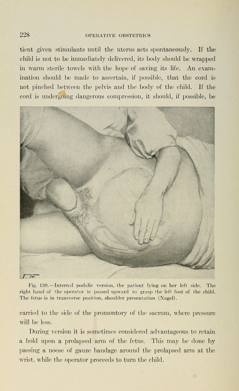 tient given stimulants until the uterus acts spontaneously. If the child is not to be. immediately delivered, its body should be wrapped in warm sterile towels with the hope of saving its life. An exam- ination should be made to ascertain, if possible, that the cord is not pinched between the pelvis and the body of the child. If the cord is undergmhg dangerous compression, it should, if possible, be I w Fig. 139.—Internal podalic version, the patient lying on her left side. The right hand of the operator is passed upward to grasp the left foot of the child. The fetus is in transverse position, shoulder presentation (Nagel). carried to the side of the promontory of the sacrum, where pressure will be less. During version it is sometimes considered advantageous to retain a hold upon a prolapsed arm of the fetus. This may be done by passing a noose of gauze bandage around the prolapsed arm at the wrist, while the operator proceeds to turn the child.