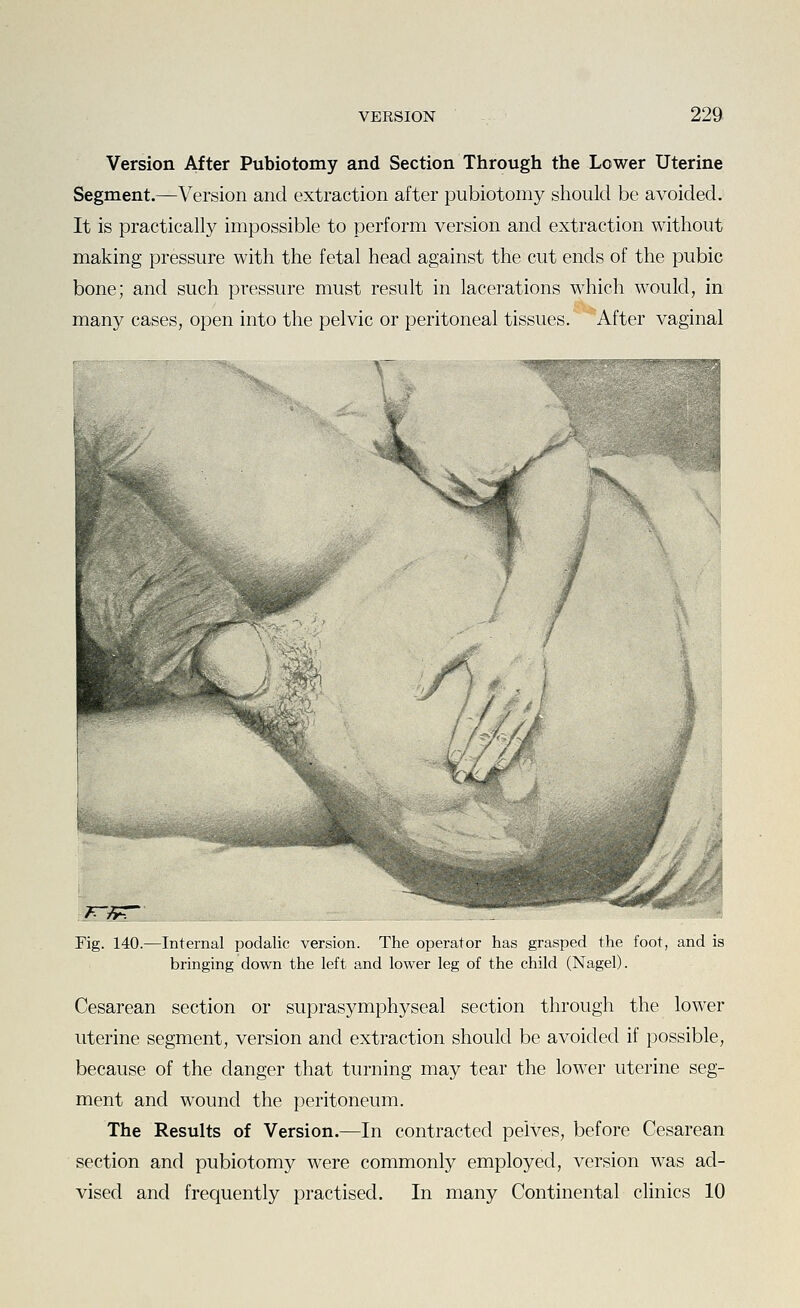 Version After Pubiotomy and Section Through the Lower Uterine Segment.—Version and extraction after pubiotomy should be avoided. It is practically impossible to perform version and extraction without making pressure with the fetal head against the cut ends of the pubic bone; and such pressure must result in lacerations which would, in many cases, open into the pelvic or peritoneal tissues. After vaginal V. \ X i*^«.*- ^^'*^m.^^:0^i;^^£mi^' Fig. 140.—Internal podalic version. The operator has grasped the foot, and is bringing down the left and lower leg of the child (Nagel). Cesarean section or suprasymphyseal section through the lower uterine segment, version and extraction should be avoided if possible, because of the danger that turning may tear the lower uterine seg- ment and wound the peritoneum. The Results of Version.—In contracted pelves, before Cesarean section and pubiotomy were commonly employed, version was ad- vised and frequently practised. In many Continental clinics 10