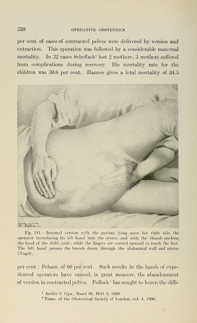 per cent, of cases of contracted pelves were delivered by version and extraction. This operation was followed by a considerable maternal mortality. In 22 cases Scheffzek^ lost 2 mothers; 3 mothers suffered from complications during recovery. His mortality rate for the children was 59.6 per cent. Hannes gives a fetal mortality of 34.5 % I Fig. 141.—Internal version with the patient lying upon her right side, the operator introducing his left hand into the uterus, and with the thumb pushing the head of the child aside; while the fingers are carried upward to reach the feet. The left hand presses the breech down through the abdominal wall and uterus (Nagel). per cent.; Peham, of 60 per cent. Such results in the hands of expe- rienced operators have caused, in great measure, the abandonment of version in contracted pelves. Pollock- has sought to lessen the diffi- 1 Archiv f. Gyn., Band 88, Heft 3, 1909. ^ Trans, of the Obstetrical Society of London, vol. 4, 1906.
