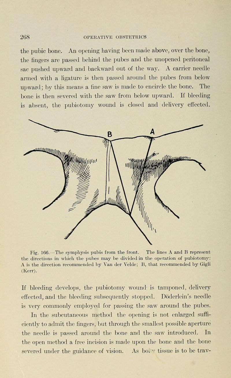 the pubic bone. An opening having been made above, over the bone, the fingers are passed behind the pubes and the unopened peritoneal sac pushed upward and backward out of the way. A carrier needle armed with a ligature is then passed around the pubes from below upward; by this means a fine saw is made to encircle the bone. The bone is then severed with the saw from below upward. If bleeding is absent, the pubiotomy wound is closed and delivery effected. Fig. 166.—The symphysis pubis from the front. The lines A and B represent the directions in which the pubes may be divided in the operation of pubiotomy: A is the direction recommended by Van der Velde; B, that recommended by Gigli (Kerr). If bleeding develops, the pubiotomy wound is tamponed, delivery effected, and the bleeding subsequently stopped. Doderlein's needle is ver}^ commonly em|)loyecl for passing the saw around the pubes. In the subcutaneous method the opening is not enlarged suffi- ciently to admit the fingers, but through the smallest possible aperture the needle is passed around the bone and the saw introduced. In the open method a free incision is made upon the bone and the bone severed under the guidance of vision. As boi v tissue is to be trav-