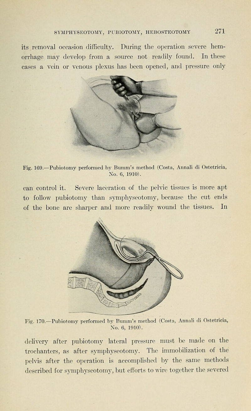 its removal occasion difficulty. During the operation severe hem- orrhage may develop from a source not readily found. In these cases a vein or venous plexus has been opened, and pressure only Fig. 169.—Pubiotomy performed by Bumm's method (Costa, Annali di Ostetricia, No. 6, 1910). can control it. Severe laceration of the pelvic tissues is more apt to follow pubiotomy than symphyseotomy, because the cut ends of the bone are sharper and more readily wound the tissues. In Fig. 170.—Pubiotomy performed by Bumm's method (Costa, Annah di Ostetricia, No. 6, 1910). delivery after pubiotomy lateral pressure must be made on the trochanters, as after symphyseotomy. The immobilization of the pelvis after the operation is accomplished by the same methods described for symphyseotomy, but efforts to wire together the severed