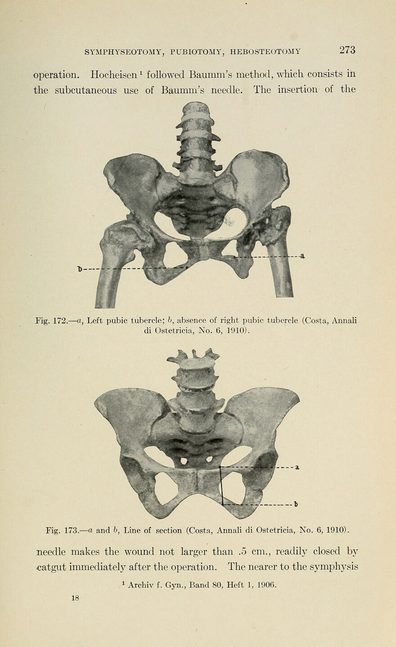 operation. Hocheisen^ followed Baumm's method, which consists in the subcutaneous use of Baumm's needle. The insertion of the D_- Fig. 172.—a, Left pubie tubercle; b, absence of right pubic tubercle (Costa, Annali di Ostetricia, No. 6, 1910). ^A L-^ Fig. 173.—a and b, Line of section (Costa, Annali di Ostetricia, No. 6, 1910). needle makes the wound not larger than .5 cm., readily closed by catgut immediately after the operation. The nearer to the symphysis 1 Archiv f. Gyn., Band 80, Heft 1, 1906. 18