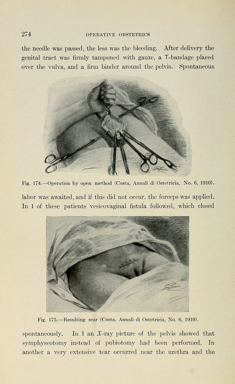 the needle was passed, the less was the bleeding. After delivery the genital tract was firmly tamponed with gauze, a T-bandage placed over the vulva, and a firm binder around the pelvis. Spontaneous Fig. 174.—Operation by open method (Costa, Annali di Ostetricia, No. 6, 1910). labor was awaited, and if this did not occur, the forceps was applied. In 1 of these patients vesicovaginal fistula followed, which closed Fig. 175.—Resulting scar (Costa, Annali di Ostetricia, No. 6, 1910). spontaneously. In 1 an A^-ray picture of the pelvis showed that, symphyseotomy instead of pubiotomy had been performed. In another a very extensive tear occurred near the urethra and the
