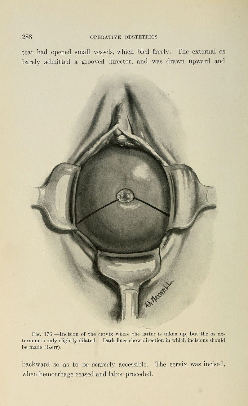 tear had opened small vessels, which bled freely. The external os barely admitted a grooved director, and was drawn upward and Fig. 176.—Incision of the cervix where the larter is taken up, but the os ex- ternum is only slightly dilated. Dark Unes show direction in which incisions should be made (Kerr). backward so as to be scarcely accessible. The cervix was incised, when hemorrhage ceased and labor proceded.