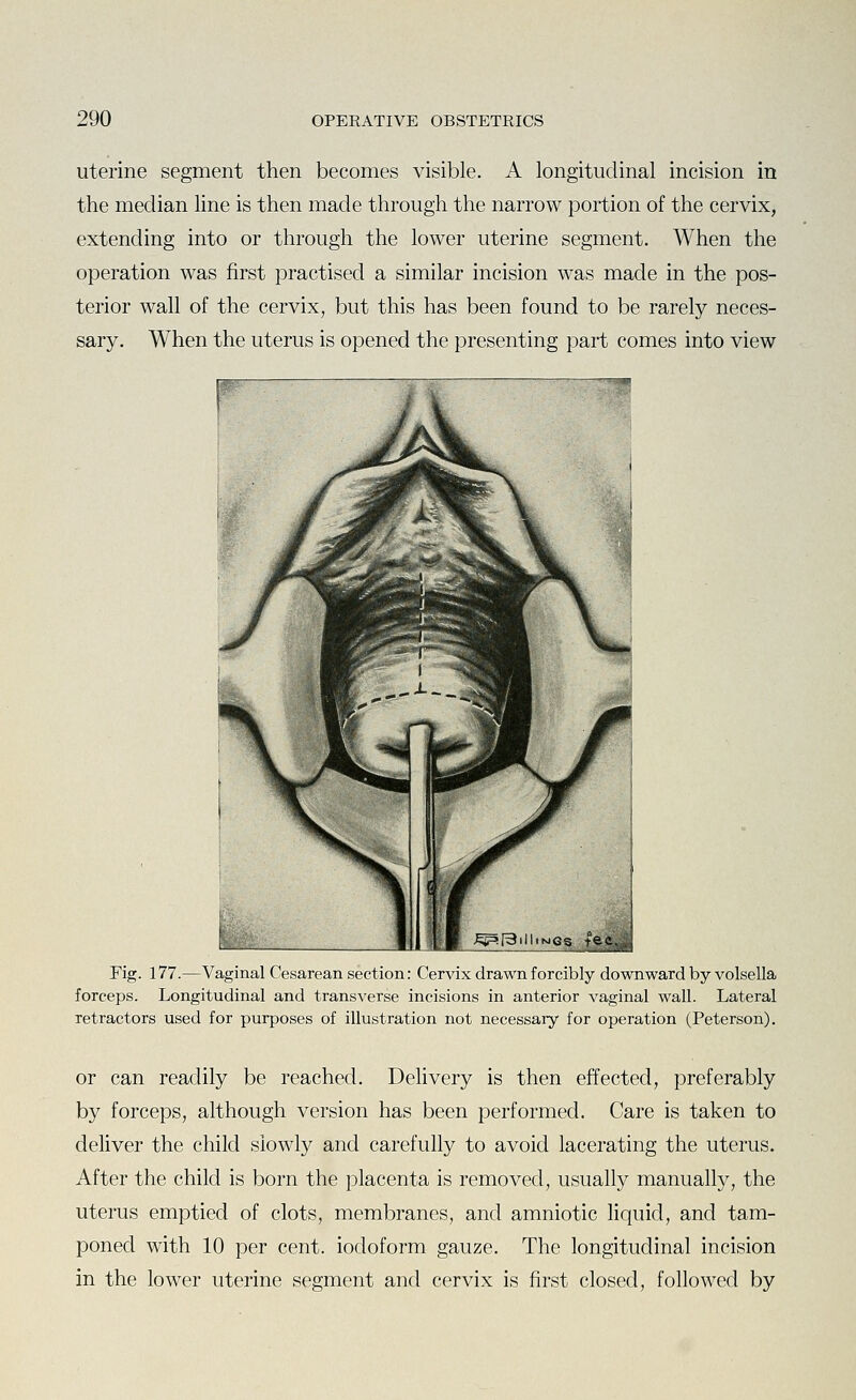 uterine segment then becomes visible. A longitudinal incision in the median line is then made through the narrow portion of the cervix, extending into or through the lower uterine segment. When the operation was first practised a similar incision was made in the pos- terior wall of the cervix, but this has been found to be rarely neces- sary. When the uterus is opened the presenting part comes into view Fig. 177.—Vaginal Cesarean section: Cervix drawn forcibly downward by volsella forceps. Longitudinal and transverse incisions in anterior vaginal wall. Lateral retractors used for purposes of illustration not necessary for operation (Peterson). or can readily be reached. Dehvery is then effected, preferably by forceps, although version has been performed. Care is taken to deliver the child slowly and carefully to avoid lacerating the uterus. After the child is born the placenta is removed, usually manually, the uterus emptied of clots, membranes, and amniotic liquid, and tam- poned with 10 per cent, iodoform gauze. The longitudinal incision in the lower uterine segment and cervix is first closed, followed by