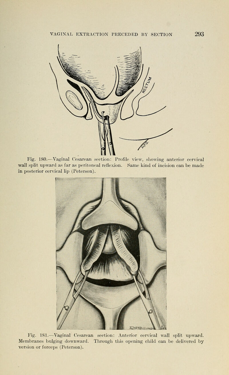Fig. 180.—Vaginal Cesarean section: Profile view, showing anterior cervical wall split upward as far as peritoneal reflexion. Same kind of incision can be made in posterior cervical lip (Peterson). Fig. 181.—Vaginal Cesarean section: Anterior cervical wall split upward. Membranes bulging downward. Through this opening child can be delivered by version or forceps (Peterson).