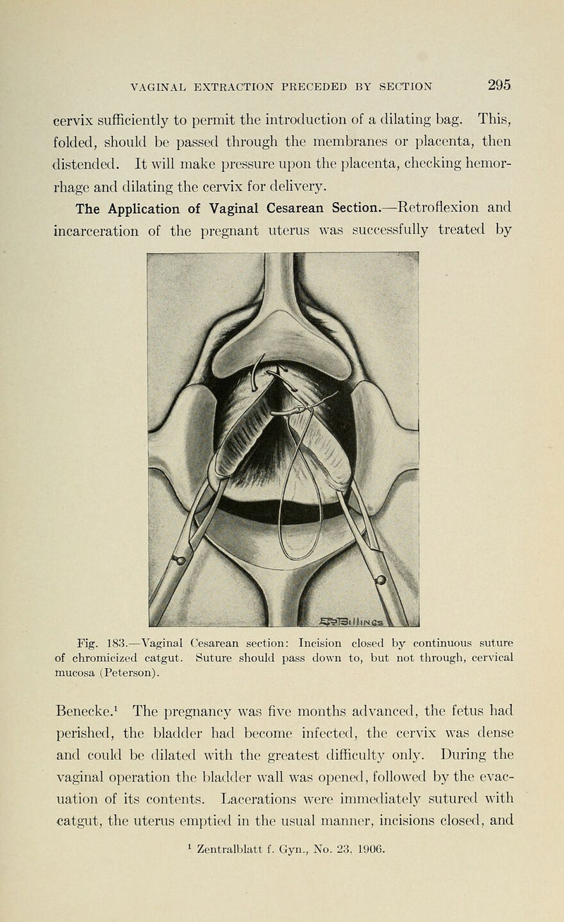 cervix sufficiently to permit the introduction of a dilating bag. This, folded, should be passed through the membranes or placenta, then distended. It wih make pressure upon the placenta, checking hemor- rhage and dilating the cervix for delivery. The Application of Vaginal Cesarean Section.—Retroflexion and incarceration of the pregnant uterus was successfully treated by Fig. 183.—Vaginal Cesarean section: Incision closed by continuous suture of chromicized catgut. Suture should pass down to, but not through, cervical mucosa (Peterson). Benecke.^ The pregnancy was five months advanced, the fetus had perished, the bladder had become infected, the cervix was dense and could be dilated with the greatest difficulty only. During the vaginal operation the bladder wall was opened, followed by the evac- uation of its contents. Lacerations were immediately sutured with catgut, the uterus emptied in the usual manner, incisions closed, and 1 Zentralblatt f. Gyn., No. 23, 1906.