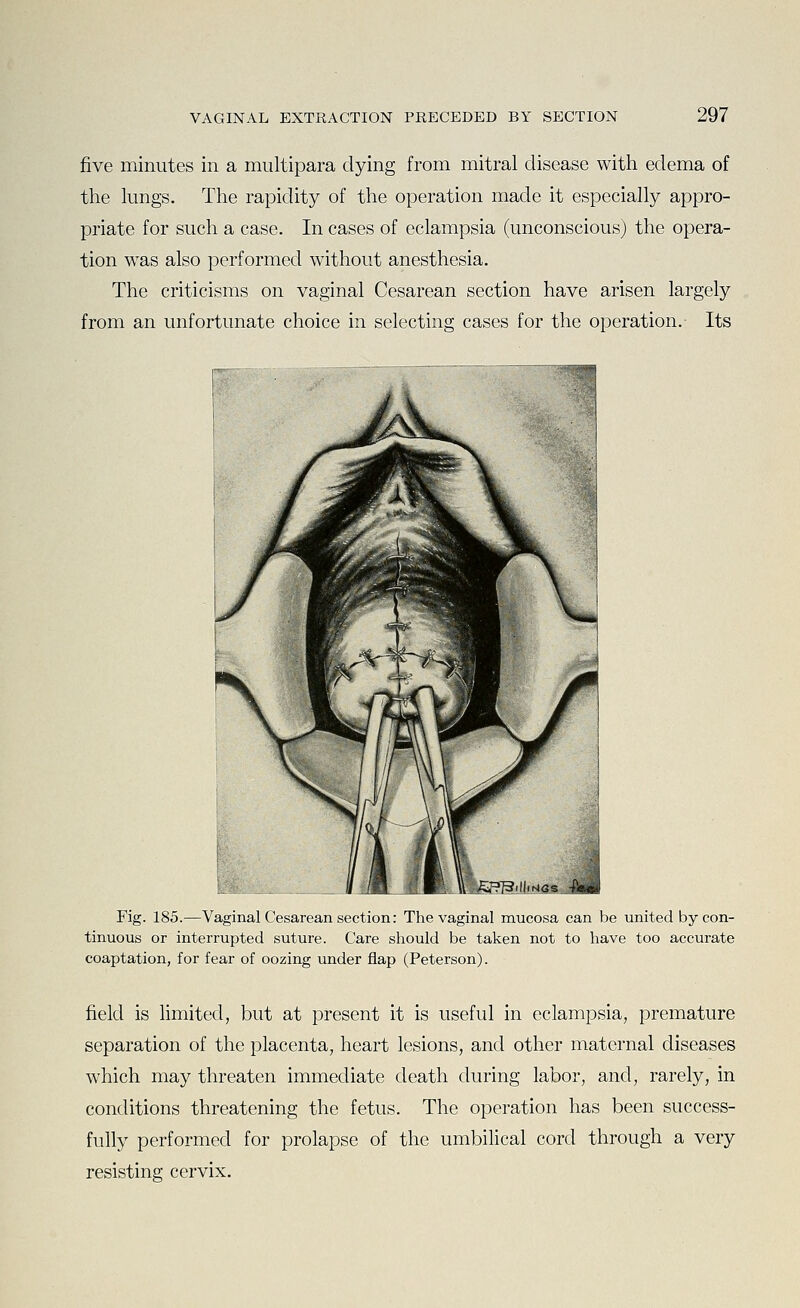 five minutes in a multipara dying from mitral disease with edema of the lungs. The rapidity of the operation made it especially appro- priate for such a case. In cases of eclampsia (unconscious) the opera- tion was also performed without anesthesia. The criticisms on vaginal Cesarean section have arisen largely from an unfortunate choice in selecting cases for the operation. Its Fig. 185.—Vaginal Cesarean section: The vaginal mucosa can be united by con- tinuous or interrupted suture. Care should be taken not to have too accurate coaptation, for fear of oozing under flap (Peterson). field is limited, but at present it is useful in eclampsia, premature separation of the placenta, heart lesions, and other maternal diseases which may threaten immediate death during labor, and, rarely, in conditions threatening the fetus. The operation has been success- fully performed for prolapse of the umbilical cord through a very resisting cervix.
