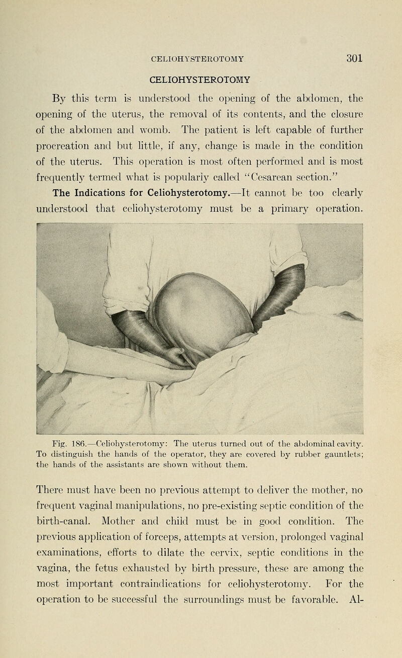 CELIOHYSTEROTOMY By this term is understood the opening of the abdomen, the opening of the uterus, the removal of its contents, and the closure of the abdomen and womb. The patient is left capable of further procreation and but little, if any, change is made in the condition of the uterus. This operation is most often performed and is most frequently termed what is popularly called ''Cesarean section. The Indications for Celiohysterotomy.—It cannot be too clearly understood that celiohysterotomy must be a primary operation. r Fig. 186.—Celiohysterotomy: The uterus turned out of the abdominal cavity. To distinguish the hands of the operator, they are covered by rubber gauntlets; the hands of the assistants are shown without them. There must have been no previous attempt to deliver the mother, no frequent vaginal manipulations, no pre-existing septic condition of the birth-canal. Mother and child must be in good condition. The previous application of forceps, attempts at version, prolonged vaginal examinations, efforts to dilate the cervix, septic conditions in the vagina, the fetus exhausted by birth pressure, these are among the most important contraindications for celiohysterotomy. For the operation to be successful the surroundings must be favorable. Al-