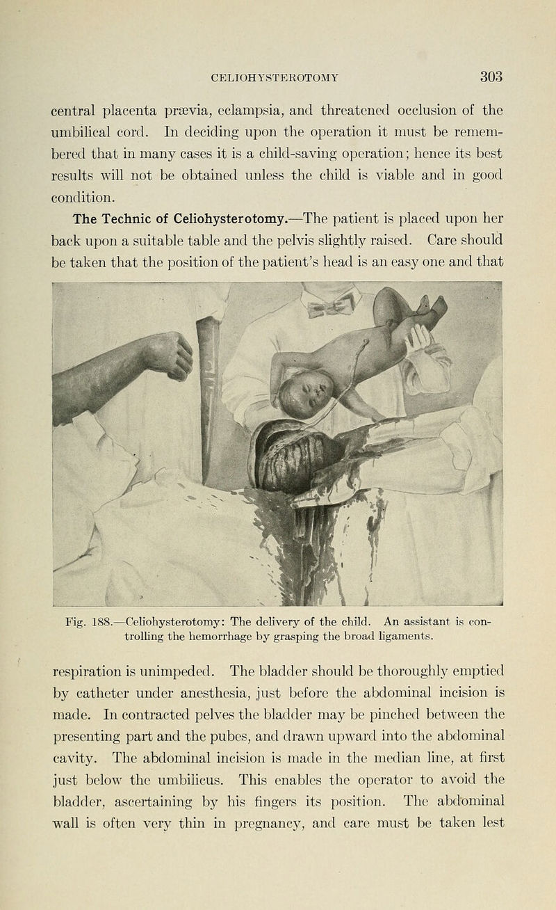 central placenta prsevia, eclampsia, and threatened occlusion of the umbilical cord. In deciding upon the operation it must be remem- bered that in many cases it is a child-saving operation; hence its best results will not be obtained unless the child is viable and in good condition. The Technic of Celiohysterotomy.—The patient is placed upon her back upon a suitable table and the pelvis slightly raised. Care should be taken that the position of the patient's head is an easy one and that Fig. 188.—Celiohysterotomy: The delivery of the child. An assistant is con- trolling the hemorrhage by grasping the broad ligaments. respiration is unimpeded. The bladder should be thoroughly emptied by catheter under anesthesia, just before the abdominal incision is made. In contracted pelves the bladder may be pinched between the presenting part and the pubes, and drawn upward into the abdominal cavity. The abdominal incision is made in the median line, at first just below the umbilicus. This enables the operator to avoid the bladder, ascertaining by his fingers its position. The abdominal wall is often very thin in pregnancy, and care must be taken lest