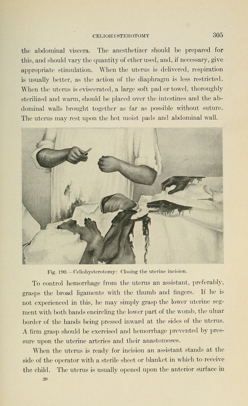 the abdominal viscera. The anesthetizer should be prepared for this, and should vary the quantity of ether used, and, if necessary, give appropriate stimulation. When the uterus is delivered, respiration is usually better, as the action of the diaphragm is less restricted. When the uterus is eviscerated, a large soft pad or towel, thoroughly steriUzed and warm, should be placed over the intestines and the ab- dominal walls brought together as far as possible without suture. The uterus may rest upon the hot moist pads and abdominal wall. Fig. 190.—Celiohysterotomy: Closing the uterine incision. To control hemorrhage from the uterus an assistant, preferably, grasps the broad ligaments with the thumb and fingers. If he is not experienced in this, he may simply grasp the lower uterine seg- ment with both hands encircling the lower part of the womb, the ulnar border of the hands being pressed inward at the sides of the uterus. A firm grasp should be exercised and hemorrhage prevented by pres- sure upon the uterine arteries and their anastomoses. When the uterus is ready for incision an assistant stands at the side of the operator with a sterile sheet or blanket in w^hich to receive the child. The uterus is usually opened upon the anterior surface in 20