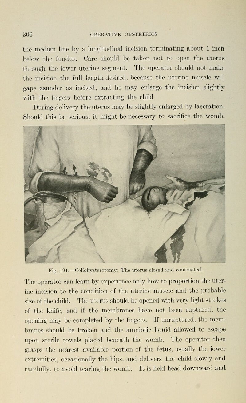 the median line by a longitudinal incision terminating about 1 inch below the fundus. Care should be taken not to open the uterus through the lower uterine segment. The operator should not make the incision the full length desired, because the uterine muscle will gape asunder as incised, and he may enlarge the incision slightly with the fingers before extracting the child During delivery the uterus may be slightly enlarged by laceration. Should this be serious, it might be necessary to sacrifice the womb. Fig. 191.—Celiohysterotomy: The uterus closed and contracted. The operator can learn by experience only how to proportion the uter- ine incision to the condition of the uterine muscle and the probable size of the child. The uterus should be opened with very light strokes of the knife, and if the membranes have not been ruptured, the opening may be completed by the fingers. If unruptured, the mem- branes should be broken and the amniotic liquid allowed to escape upon sterile towels placed beneath the womb. The operator then grasps the nearest available portion of the fetus, usually the lower extremities, occasionally the hips, and delivers the child slowly and carefully, to avoid tearing the womb. It is held head downward and