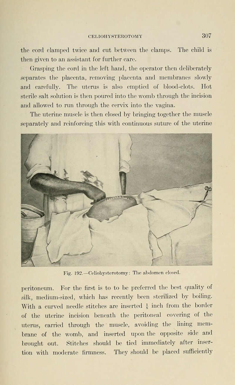 the cord clamped twice and cut between the clamps. The child is then given to an assistant for further care. Grasping the cord in the left hand, the operator then deliberately separates the placenta, removing placenta and membranes slowly and carefully. The uterus is also emptied of blood-clots. Hot sterile salt solution is then poured into the womb through the incision and allowed to run through the cervix into the vagina. The uterine muscle is then closed by bringing together the muscle separately and reinforcing this with continuous suture of the uterine Fig. 192.—Celiohysterotomy: The abdomen closed. peritoneum. For the first is to to be preferred the best ciuality of silk, medium-sized, which has recently been sterilized by boiling. With a curved needle stitches are inserted | inch from the border of the uterine incision beneath the peritoneal covering of the uterus, carried through the muscle, avoiding the lining mem- brane of the womb, and inserted upon the opposite side and brought out. Stitches should be tied immediately after inser- tion with moderate firmness. They should be placed sufficiently