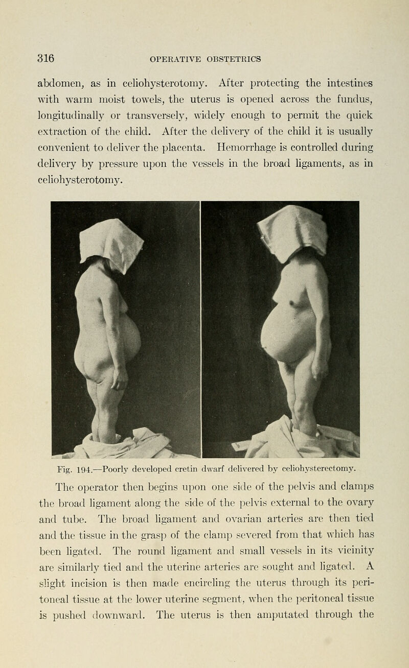 abdomen, as in celiohysterotomy. After protecting the intestines with warm moist towels, the uterus is opened across the fundus, longitudinally or transversely, widely enough to permit the quick extraction of the child. After the delivery of the child it is usually convenient to deliver the placenta. Hemorrhage is controlled during delivery by pressure upon the vessels in the broad hgaments, as in celiohysterotomy. Fig. 194.—Poorly developed cretin dwarf delivered by celiohysterectomy. The operator then begins upon one side of the pelvis and clamps the broad ligament along the side of the pelvis external to the ovary and tube. The broad ligament and ovarian arteries are then tied and the tissue in the grasp of the clamp severed from that which has been ligated. The round ligament and small vessels in its vicinity are similarly tied and the uterine arteries are sought and ligated. A slight incision is then made encircling the uterus through its peri- toneal tissue at the lower uterine segment, when the peritoneal tissue is pushed downward. The uterus is then amputated through the