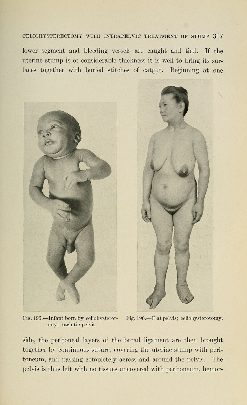 lower segment and bleeding vessels are caught and tied. If the uterine stump is of considerable thickness it is well to bring its sur- faces together with buried stitches of catgut. Beginning at one H/ Fig. 195.—Infant born by celiohysterot- omy; rachitic pelvis. Fig. 196.^Flat pelvis; celiohysterotomy. side, the peritoneal layers of the broad ligament are then brought together by continuous suture, covering the uterine stump with peri- toneum, and passing completely across and around the pelvis. The pelvis is thus left with no tissues uncovered with peritoneum, hemor-