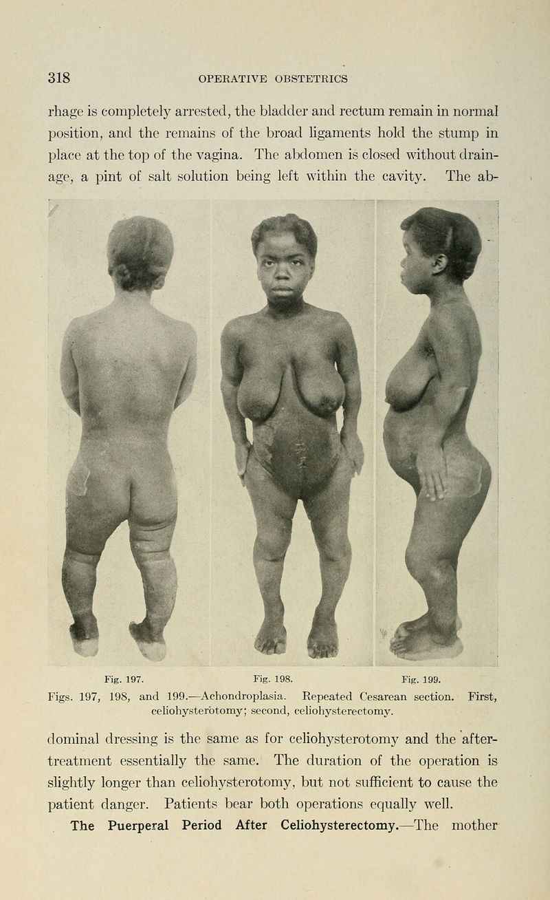 rhage is completely arrested, the bladder and rectum remain in normal position, and the remains of the broad ligaments hold the stump in place at the top of the vagina. The abdomen is closed without drain- age, a pint of salt solution being left within the cavity. The ab- Fig. 197. Fig. 198. Fig. 199. Figs. 197, 198, and 199.—Achondroplasia. Repeated Cesarean section. First, celiohysterbtomy; second, celiohysterectomy. dominal dressing is the same as for celiohysterotomy and the after- treatment essentially the same. The duration of the operation is slightly longer than celiohysterotomy, but not sufficient to cause the patient danger. Patients bear both operations equally well. The Puerperal Period After Celiohysterectomy.—The mother