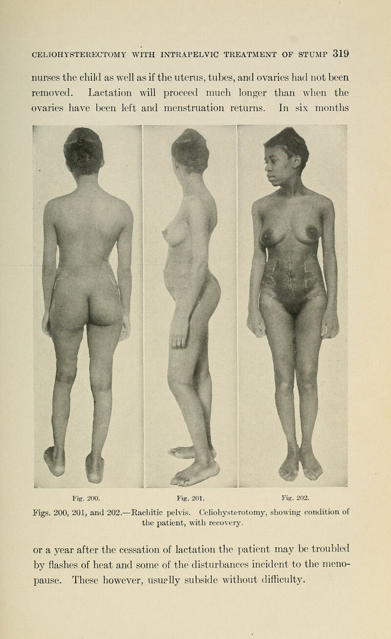 nurses the child as well as if the uterus, tubes, and ovaries had not been removed. Lactation will proceed much longer than when the ovaries have been left and menstruation returns. In six months Fig. 200. Fig. 201. Fig. 202. Figs. 200, 201, and 202.—Rachitic pelvis. Celiohysterotomy, showing condition of the patient, with recovery. or a year after the cessation of lactation the patient may be troubled by flashes of heat and some of the disturbances incident to the meno- pause. These however, usuplly subside without difficulty.