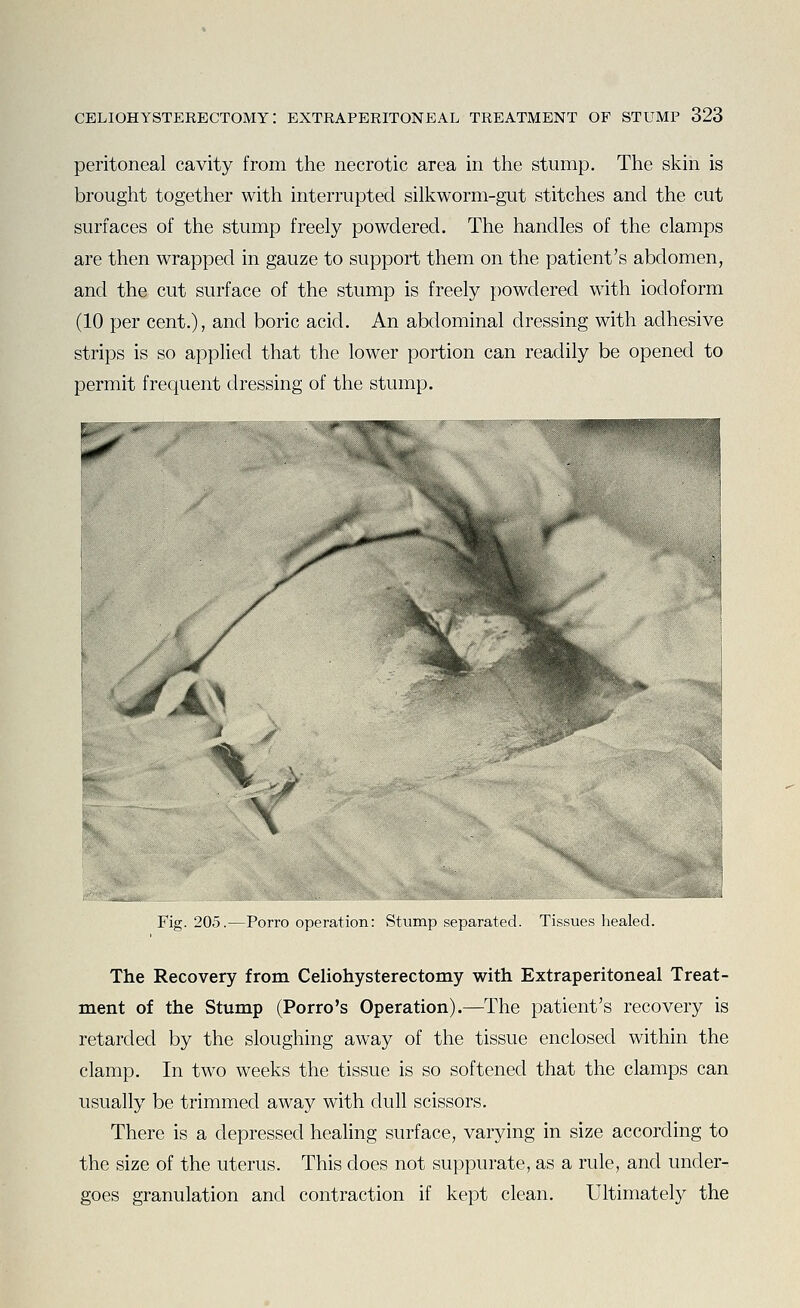 peritoneal cavity from the necrotic area in the stump. The skin is brought together with interrupted silkworm-gut stitches and the cut surfaces of the stump freely powdered. The handles of the clamps are then wrapped in gauze to support them on the patient's abdomen, and the cut surface of the stump is freely powdered with iodoform (10 per cent.), and boric acid. An abdominal dressing with adhesive strips is so applied that the lower portion can readily be opened to permit frequent dressing of the stump. Fig. 205.—Porro operation: Stump separated. Tissues healed. The Recovery from Celiohysterectomy with Extraperitoneal Treat- ment of the Stump (Porro's Operation).—The patient's recovery is retarded by the sloughing away of the tissue enclosed within the clamp. In two weeks the tissue is so softened that the clamps can usually be trimmed away with dull scissors. There is a depressed healing surface, varying in size according to the size of the uterus. This does not suppurate, as a rule, and under- goes granulation and contraction if kept clean. Ultimately the