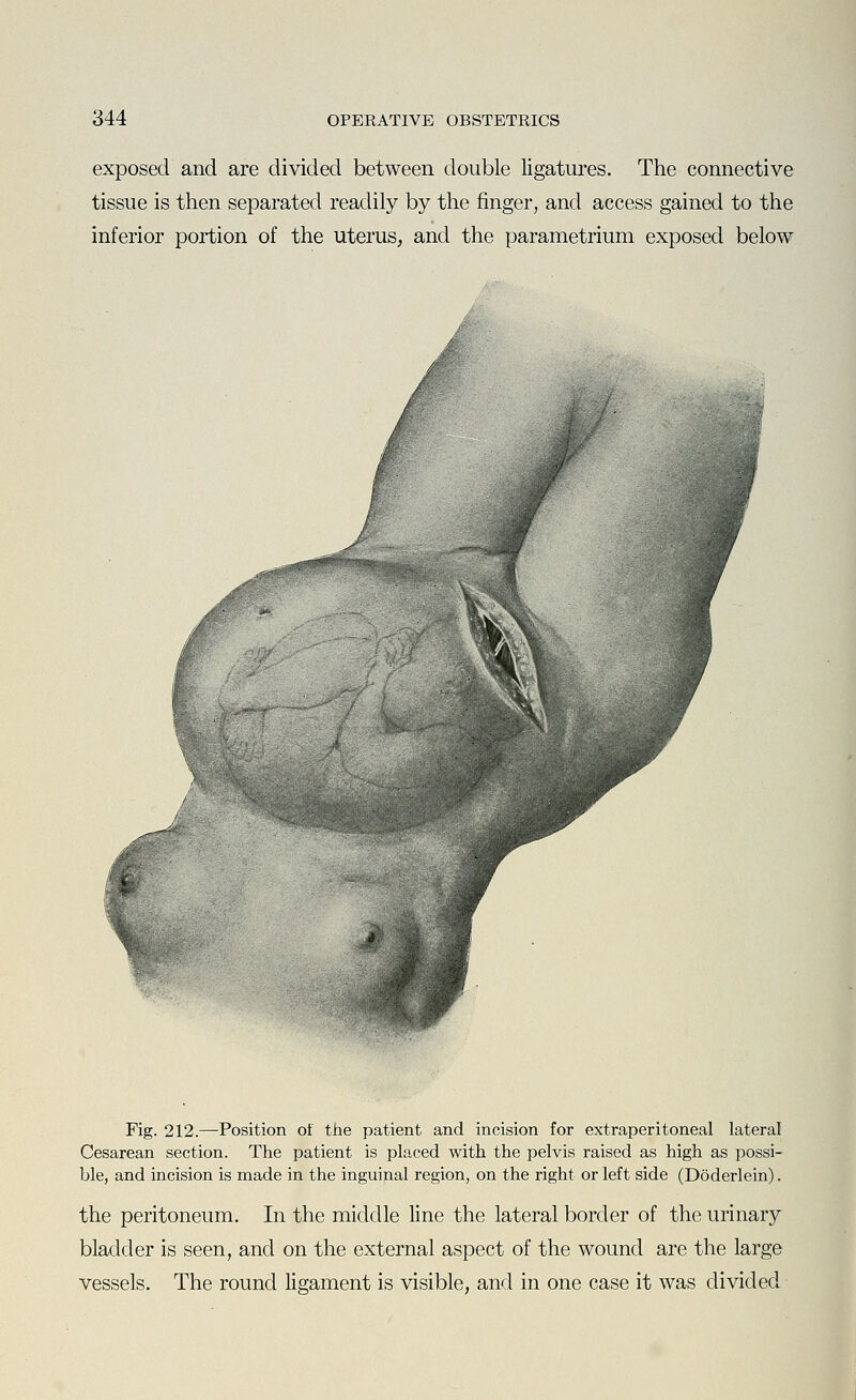 exposed and are divided between double ligatures. The connective tissue is then separated readily by the finger, and access gained to the inferior portion of the uterus, and the parametrium exposed below Fig. 212.—Position of the patient and incision for extraperitoneal lateral Cesarean section. The patient is placed with the pelvis raised as high as possi- ble, and incision is made in the inguinal region, on the right or left side (Doderlein). the peritoneum. In the middle line the lateral border of the urinary bladder is seen, and on the external aspect of the wound are the large vessels. The round ligament is visible, and in one case it was divided