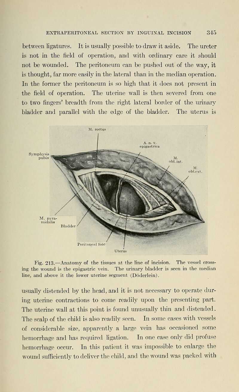 between ligatures. It is usually possible to draw it aside. The ureter is not in the field of operation, and with ordinary care it should not be wounded. The peritoneum can be pushed out of the way, it is thought, far more easily in the lateral than in the median operation. In the former the peritoneum is so high that it does not present in the field of operation. The uterine wall is then severed from one to two fingers' breadth from the right lateral border of the urinary bladder and parallel with the edge of the bladder. The uterus is M. ob!. int. Fig. 213.—Anatomy of the tissues at the line of incision. The vessel cross- ing the wound is the epigastric vein. The urinary bladder is seen in the median line, and above it the lower uterine segment (Doderlein). usually distended by the head, and it is not necessary to operate dur- ing uterine contractions to come readily upon the presenting part. The uterine wall at this point is found unusually thin and distended. The scalp of the child is also readily seen. In some cases with vessels of considerable size, apparently a large vein has occasioned some hemorrhage and has required ligation. In one case only did profuse hemorrhage occur. In this patient it was impossible to enlarge the wound sufficiently to deliver the child, and the wound was packed with