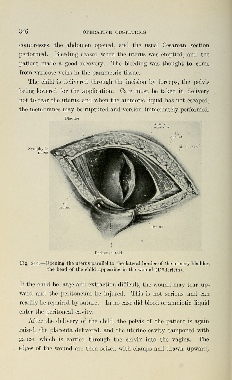 compresses, the abdomen opened, and the usual Cesarean section performed. Bleeding ceased when the uterus was emptied, and the patient made a good recovery. The bleeding was thought to come from varicose veins in the parametric tissue. The child is delivered through the incision by forceps, the pelvis being lowered for the application. Care must be taken in delivery not to tear the uterus, and when the amniotic liquid has not escaped, the membranes may be ruptured and version immediately performed. Sjrmphysis pubis Peritoneal fold Fig. 214.—Opening the uterus parallel to the lateral border of the urinary bladder, the head of the child appearing in the wound (Doderlein). If the child be large and extraction difficult, the wound may tear up- ward and the peritoneum be injured. This is not serious and can readily be repaired by suture. In no case did blood or amniotic liquid enter the peritoneal cavity. After the delivery of the child, the pelvis of the patient is again raised, the placenta delivered, and the uterine cavity tamponed with gauze, which is carried through the cervix into the vagina. The edges of the wound are then seized with clamps and drawn upward,