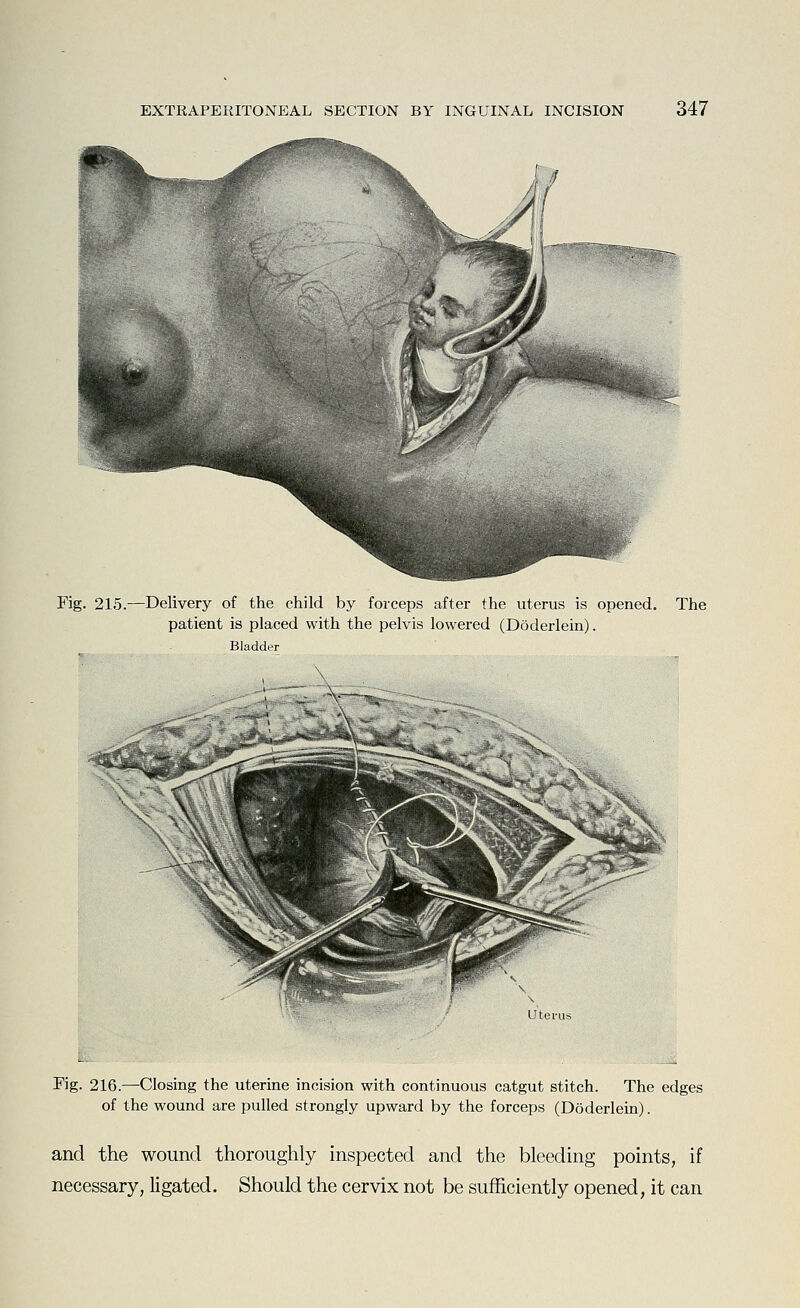 Fig. 215.—Delivery of the child by forceps after the uterus is opened. The patient is placed with the pelvis lowered (Doderlein). Bladder Utevus Fig. 216.—Closing the uterine incision with continuous catgut stitch. The edges of the wound are pulled strongly upward by the forceps (Doderlein). and the wound thoroughly inspected and the bleeding points, if necessary, ligated. Should the cervix not be sufficiently opened, it can