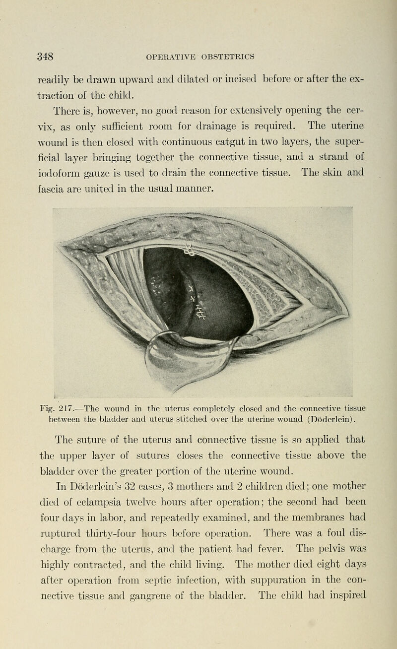 readily be drawn upward and dilated or incised before or after the ex- traction of the child. There is, however, no good reason for extensively opening the cer- vix, as only sufficient room for drainage is required. The uterine wound is then closed with continuous catgut in two layers, the super- ficial layer bringing together the connective tissue, and a strand of iodoform gauze is used to drain the connective tissue. The skin and fascia are united in the usual manner. Fig. 217.—The wound in the uterus completely closed and the connective tissue between the bladder and uterus stitched over the uterine wound (Doderlein). The suture of the uterus and connective tissue is so applied that the upper layer of sutures closes the connective tissue above the bladder over the greater portion of the uterine wound. In Doderlein's 32 cases, 3 mothers and 2 children died; one mother died of eclampsia twelve hours after operation; the second had been four days in labor, and repeatedly examined, and the membranes had ruptured thirty-four hours before operation. There was a foul dis- charge from the uterus, and the patient had fever. The pelvis was highly contracted, and the child living. The mother died eight days after operation from septic infection, with suppuration in the con- nective tissue and gangrene of the bladder. The child had inspired