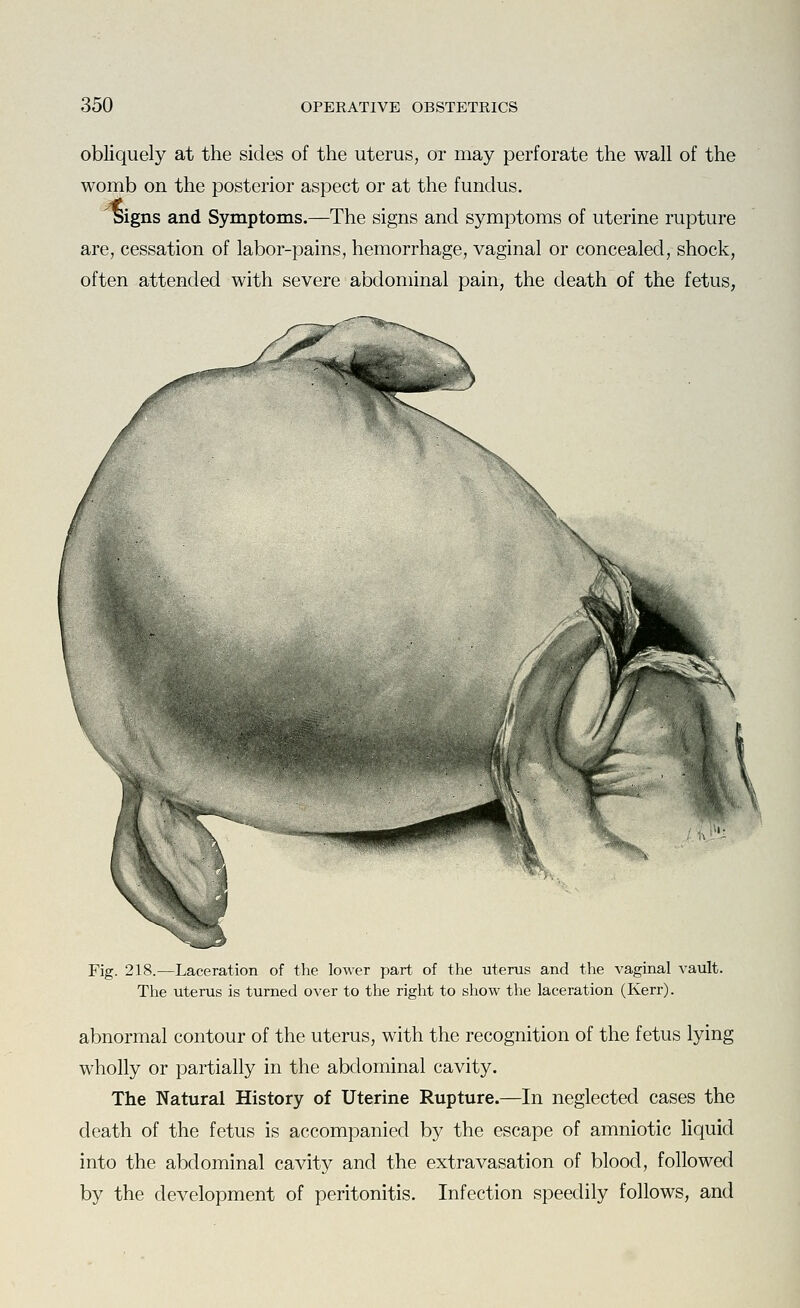 obliquely at the sides of the uterus, or may perforate the wall of the womb on the posterior aspect or at the fundus. signs and Symptoms.—The signs and symptoms of uterine rupture are, cessation of labor-pains, hemorrhage, vaginal or concealed, shock, often attended with severe abdominal pain, the death of the fetus, Fig. 218.—Laceration of the lower part of the uterus and the vaginal vault. The uterus is turned over to the right to show the laceration (Kerr). abnormal contour of the uterus, with the recognition of the fetus lying wholly or partially in the abdominal cavity. The Natural History of Uterine Rupture.—In neglected cases the death of the fetus is accompanied by the escape of amniotic liquid into the abdominal cavity and the extravasation of blood, followed by the development of peritonitis. Infection speedily follows, and