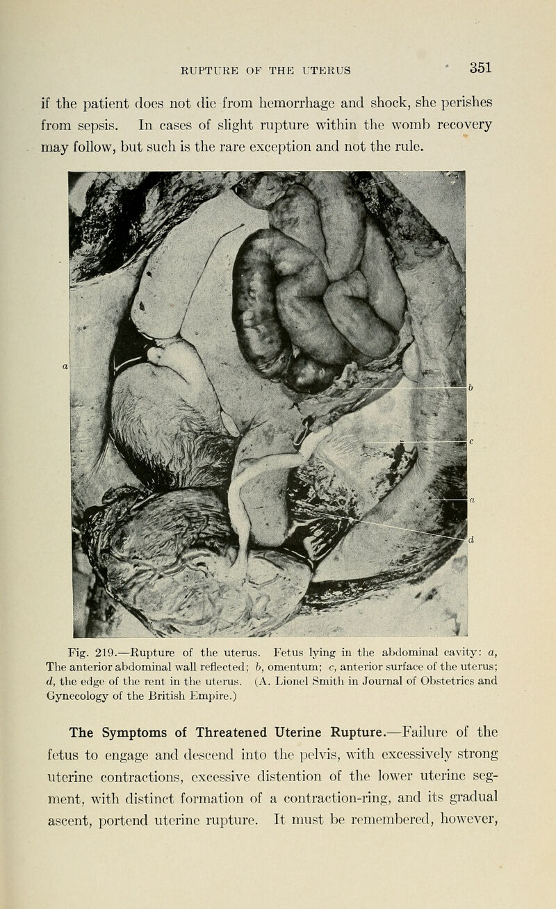 if the patient does not die from hemorrhage and shock, she perishes from sepsis. In cases of slight rupture within the womb recovery may follow, but such is the rare exception and not the rule. Fig. 219.—Rupture of the uterus. Fetus lying in the abdominal cavity: a, The anterior abdominal wall reflected; h, omentum; c, anterior surface of the uterus; d, the edge of the rent in the uterus. (A. Lionel Smith in Journal of Obstetrics and Gynecology of the British Empire.) The Symptoms of Threatened Uterine Rupture.—Failure of the fetus to engage and descend into the pelvis, with excessively strong uterine contractions, excessive distention of the lower uterine seg- ment, with distinct formation of a contraction-ring, and its gradual ascent, portend uterine rupture. It must be remembered, however,