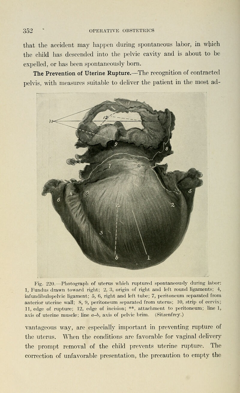that the accident may happen during spontaneous labor, in which the child has descended into the pelvic cavity and is about to be expelled, or has been spontaneously born. The Prevention of Uterine Rupture.—The recognition of contracted pelvis, with measures suitable to deUver the patient in the most ad- Fig. 220.—Photograph of uterus which ruptured spontaneously during labor: I, Fundus drawn toward right; 2, 3, origin of right and left round ligaments; 4, infundibulopelvic ligament; 5, 6, right and left tube; 7, peritoneum separated from anterior uterine wall; 8, 9, peritoneum separated from uterus; 10, strip of cervix; II, edge of rupture; 12, edge of incision; **, attachment to peritoneum; line 1, axis of uterine muscle; line a-b, axis of pelvic brim. (Sitzenfrey.) vantageous way, are especially important in preventing rupture of the uterus. When the conditions are favorable for vaginal delivery the prompt removal of the child prevents uterine rupture. The correction of unfavorable presentation, the precaution to empty the