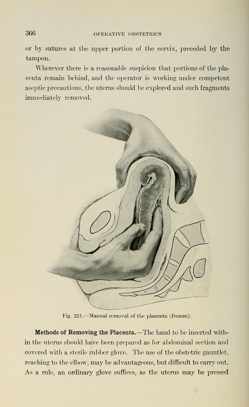 or by sutures at the upper portion of the cervix, preceded by the tampon. Wherever there is a reasonable suspicion that portions of the pla- centa remain behind, and the operator is working under competent aseptic precautions, the uterus should be explored and such fragments immediately removed. '*~*x Fig. 221.—Manual removal of the placenta (Bumm). Methods of Removing the Placenta.—The hand to be inserted with- in the uterus should have been prepared as for abdominal section and covered with a sterile rubber glove. The use of the obstetric gauntlet, reaching to the elbow, may be advantageous, but difficult to carry out. As a rule, an ordinary glove suffices, as the uterus may be pressed