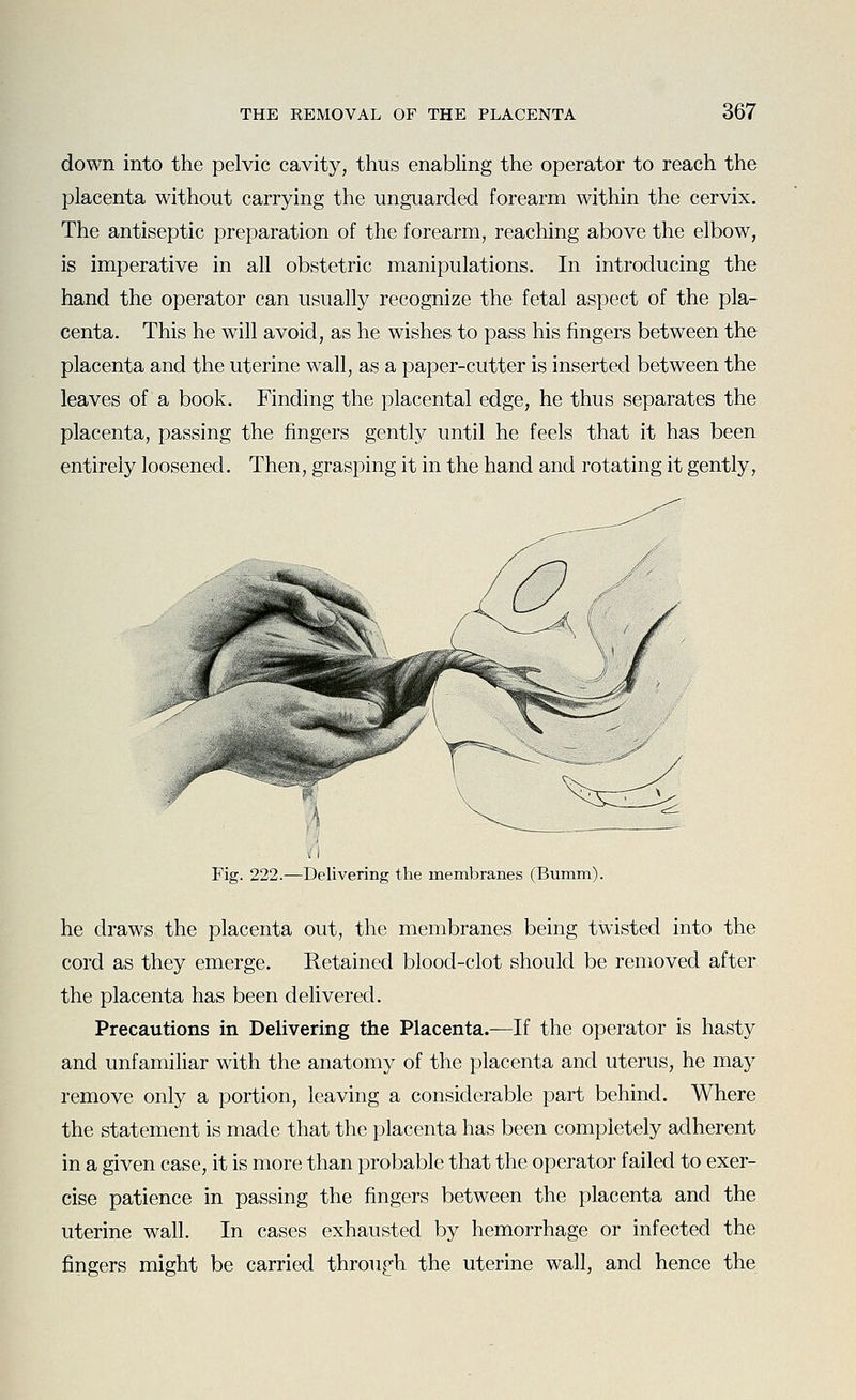 down into the pelvic cavity, thus enabhng the operator to reach the placenta without carrying the unguarded forearm within the cervix. The antiseptic preparation of the forearm, reaching above the elbow, is imperative in all obstetric manipulations. In introducing the hand the operator can usually recognize the fetal aspect of the pla- centa. This he will avoid, as he wishes to pass his fingers between the placenta and the uterine wall, as a paper-cutter is inserted between the leaves of a book. Finding the placental edge, he thus separates the placenta, passing the fingers gently until he feels that it has been entirely loosened. Then, grasping it in the hand and rotating it gently, Fig. 222.—Delivering the membranes (Bumm). he draws the placenta out, the membranes being twisted into the cord as they emerge. Retained blood-clot should be removed after the placenta has been delivered. Precautions in Delivering the Placenta.—If the operator is hasty and unfamiliar with the anatomy of the placenta and uterus, he may remove only a portion, leaving a considerable part behind. Where the statement is made that the placenta has been completely adherent in a given case, it is more than probable that the operator failed to exer- cise patience in passing the fingers between the placenta and the uterine wall. In cases exhausted by hemorrhage or infected the fingers might be carried through the uterine wall, and hence the