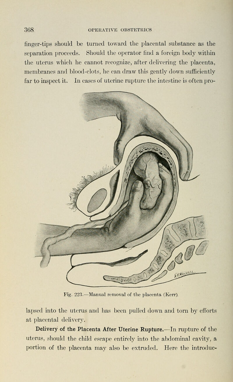 finger-tips should be turned toward the placental substance as the separation proceeds. Should the operator find a foreign body within the uterus which he cannot recognize, after delivering the placenta, membranes and blood-clots, he can draw this gently clown sufficiently far to inspect it. In cases of uterine rupture the intestine is often pro- Fig. 223.—Manual removal of the placenta (Kerr), lapsed into the uterus and has been pulled down and torn by efforts at placental delivery. Delivery of the Placenta After Uterine Rupture.—In rupture of the uterus, should the child escape entirely into the abdominal cavity, a portion of the placenta may also be extruded. Here the introduc-