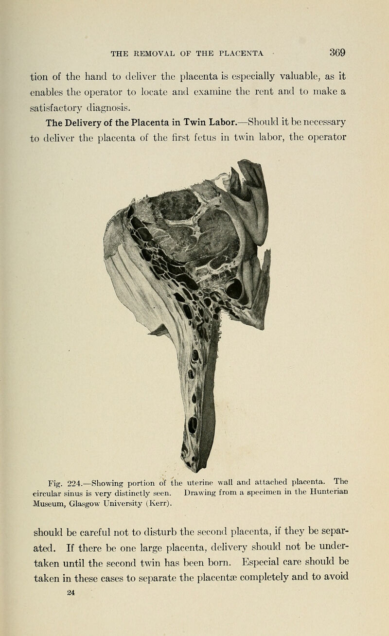 tion of the hand to deliver the placenta is especially valuable, as it enables the operator to locate and examine the rent and to make a satisfactory diagnosis. The Delivery of the Placenta in Twin Labor.—Should it be necessary to dehver the placenta of the first fetus in twin labor, the operator Fig. 224.—Showing portion of the uterine wail and attached placenta. The circular sinus is very distinctly seen. Drawing from a specimen in the Hunterian Museum, Glasgow University (Kerr). should be careful not to disturb the second placenta, if they be separ- ated. If there be one large placenta, delivery should not be under- taken until the second twin has been born. Especial care should be taken in these cases to separate the placenta? completely and to avoid 24